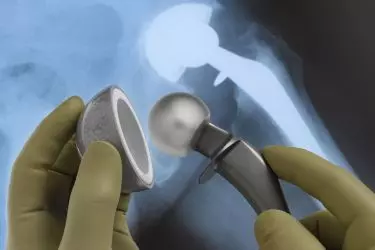 best hospital for hip replacement surgery in narsinghpur, best doctor for hip replacement surgery in narsinghpur, cost of hip replacement surgery in narsinghpur