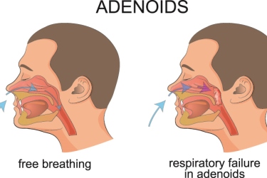 best hospital for ademoids surgery in narsinghpur, best doctor for adenoids treatment in narsinghpur, cost of adenotonsillectomy surgery in narsinghpur