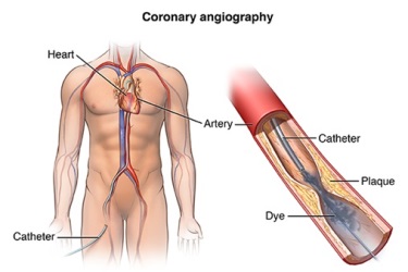 coronary angiography in narsinghpur, angiography of heart in narsinghpur