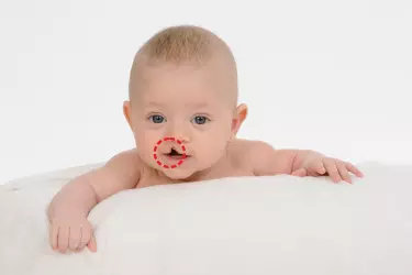 best hospital for cleft lip palate surgery in Narsinghpur, best doctor for cleft lip palate surgery in Narsinghpur, cost of cleft lip palate surgery in Narsinghpur