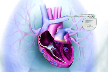 Pacemaker Device Implant, Treatment for Irregular Heart Beat, Cost of Pacemaker Device Surgery, LNM Hospital, Narsinghpur