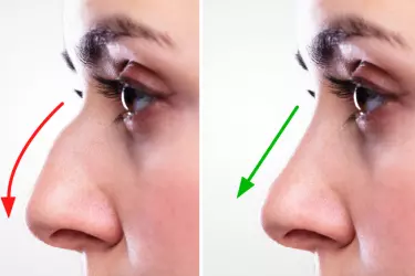 best hospital for nose correction surgery in narsinghpur, best doctor for rhinoplasty surgery in narsinghpur, cost of nose correction surgery in narsinghpur