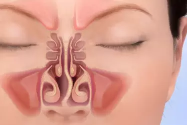 best hospital for septoplasty surgery in narsinghpur, best doctor for septoplasty surgery in narsinghpur, cost of septoplasty surgery in narsinghpur